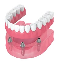 AllOn4Implants