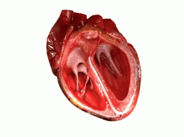 Heartattack