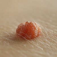 Humanpapillomavirus