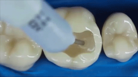 How your broken teeth is fixed Gif