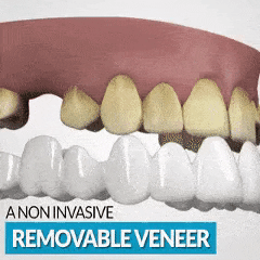 The SmartSmile™ Snap On Perfect Smile Veneers guarantees the most natural veneer replacement of your natural teeth. It provides adjustability, accurate fitting, and no discomfort.