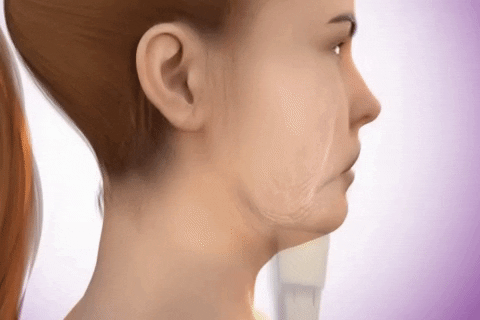 My Face Lift: Il massaggiatore per collo e mento che aiuta a ridurre la dimensione del doppio mento