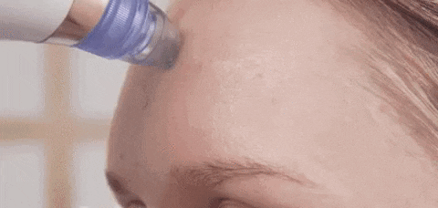 PoreVacuum™ Pore Cleanser & Blackhead Remover | BOSKI