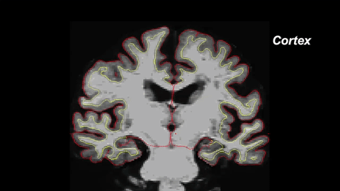 https://news.northwestern.edu/stories/2017/april/alzheimers-research-superagers-brain-shrinkage/