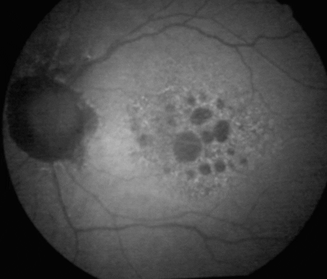 Atrophic Amd Progression GIF