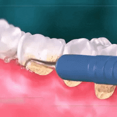 Ultrasonic tooth cleaner can effectively separate dental plaque, dental calculus, and stains, removes hard tartar easily from the teeth preventing gum disease.