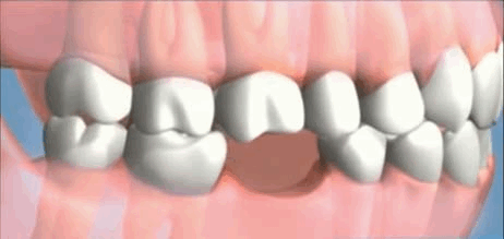  tooth GIF