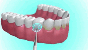Détartreur Dentaire à Ultrasons