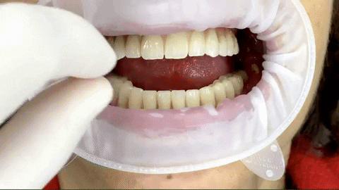 All on 4 si all on 6 implant dentar 1
