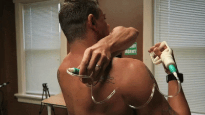 cupping therapy