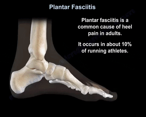 stabbing pain in arch of foot