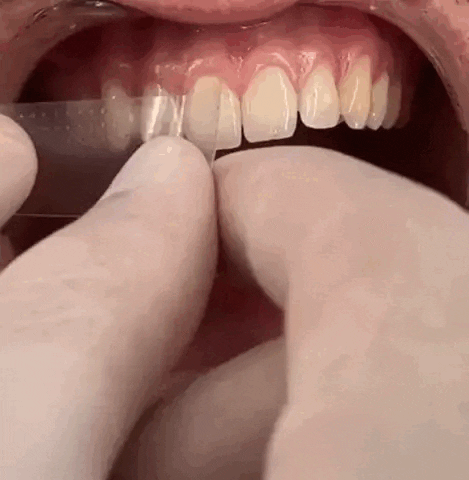 teste da fita clareadora para os dentes, tratamento eficaz logo na primeira aplicação