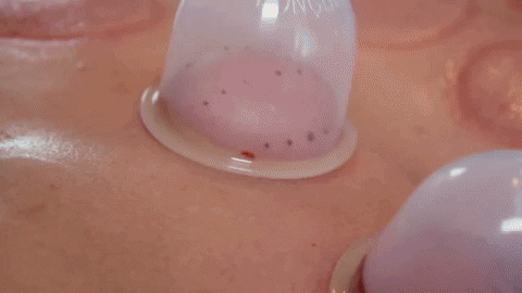 Hijama Therapy: Wet Cupping and its Benefits
