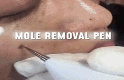 Mirnala plasma pen mole  freckle remover  قلم البلازما المعالج لمشاكل البشرة