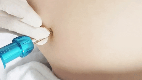 Intradermoterapia Pressurizada sem agulha 4 Intradermoterapia Pressurizada sem agulha 3