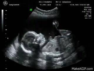fetal heartbeat 12 weeks