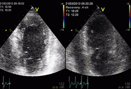 heart doppler ultrasound