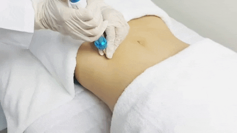 Intradermoterapia Pressurizada sem agulha 7 Intradermoterapia Pressurizada sem agulha 5