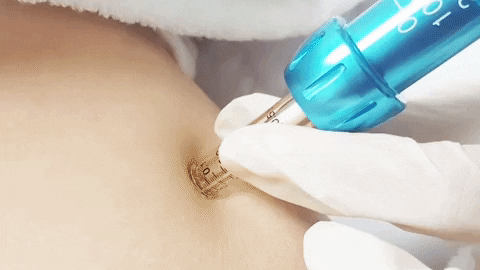 Intradermoterapia Pressurizada sem agulha 5 Intradermoterapia Pressurizada sem agulha 4