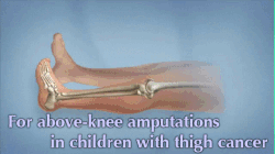 amputation